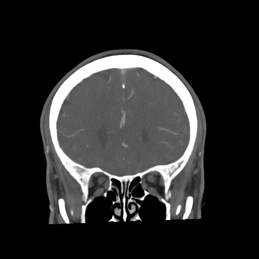 Cerebral arteriovenous malformation with lobar hemorrhage (Radiopaedia 35598-57216 C 27).jpg