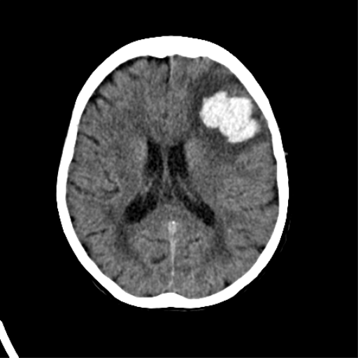 File:Cerebral arteriovenous malformation with lobar hemorrhage (Radiopaedia 44725-48510 Axial non-contrast 25).png
