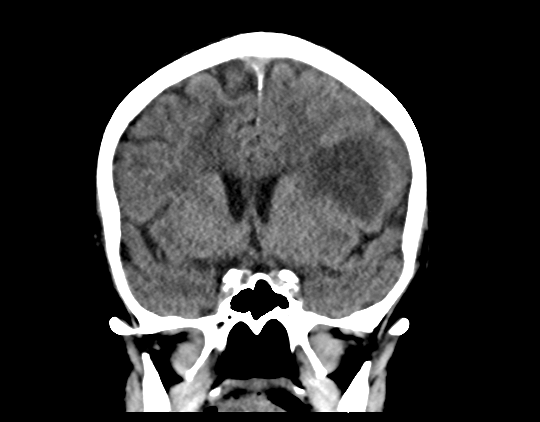 Cerebral arteriovenous malformation with lobar hemorrhage (Radiopaedia 44725-48510 Coronal non-contrast 22).png
