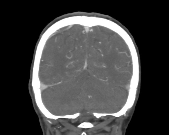 Cerebral arteriovenous malformation with lobar hemorrhage (Radiopaedia 44725-48511 A 46).png