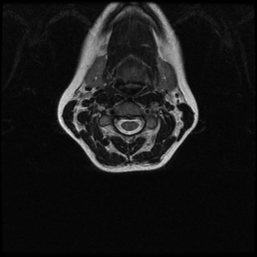 File:Cerebral autosomal dominant arteriopathy with subcortical infarcts and leukoencephalopathy (CADASIL) (Radiopaedia 41018-43763 Ax T2 C2-T1 34).png