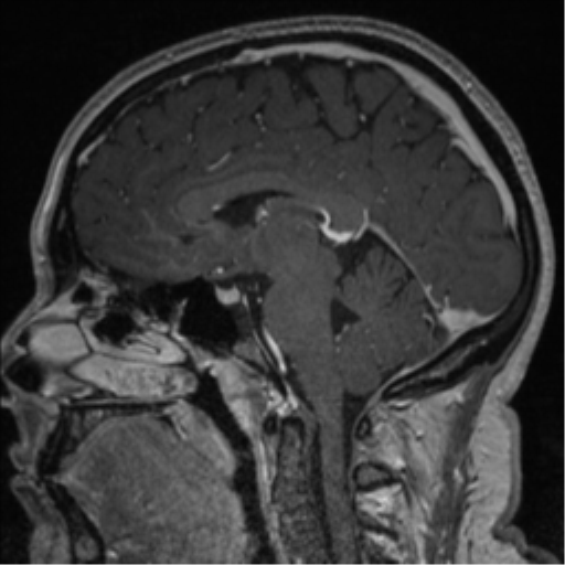 Cerebral cavernoma and development venous anomaly (Radiopaedia 37603-39482 Sagittal T1 C+ 47).png