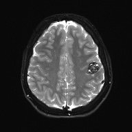 Cerebral cavernous venous malformation (Radiopaedia 70008-80021 Axial DWI 23).jpg