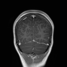 Cerebral cavernous venous malformation (Radiopaedia 70008-80021 Coronal T1 C+ 13).jpg