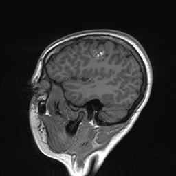 File:Cerebral cavernous venous malformation (Radiopaedia 70008-80021 Sagittal T1 16).jpg