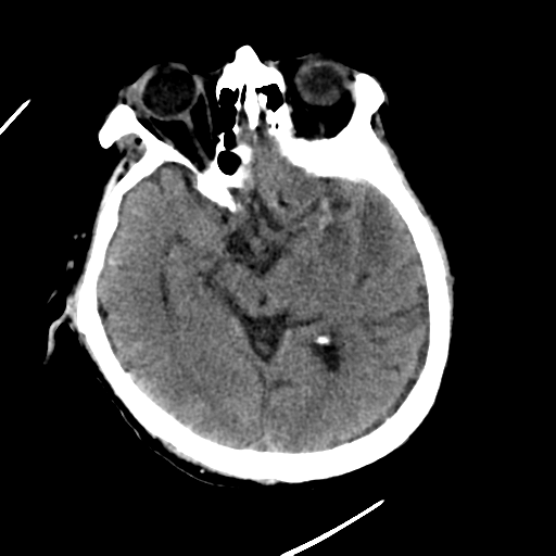 File:Cerebral contusions, subarachnoid hemorrhage and subdural hygromas (Radiopaedia 55399-61830 Axial non-contrast 14).png
