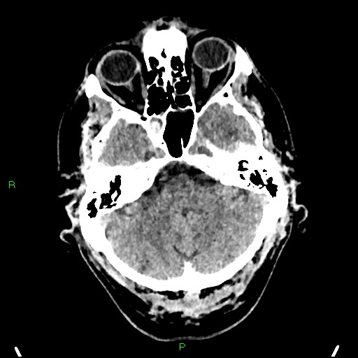 Cerebral contusions (Radiopaedia 33868-35039 Axial non-contrast 44).jpg