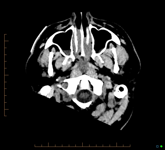 Cerebral fat embolism (Radiopaedia 85521-101224 Axial non-contrast 2).jpg