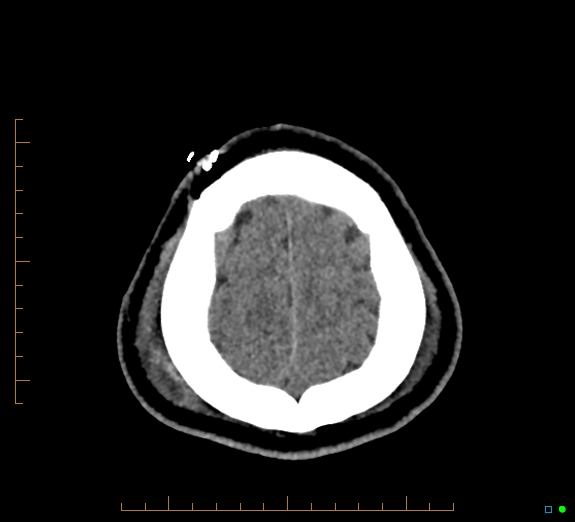File:Cerebral fat embolism (Radiopaedia 85521-101224 Axial non-contrast 46).jpg