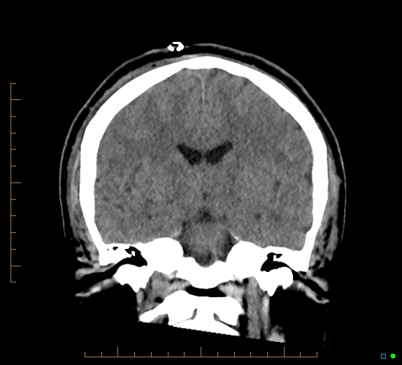Cerebral fat embolism (Radiopaedia 85521-101224 Coronal non-contrast 33).jpg