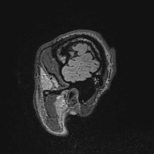 File:Cerebral hemorrhagic contusions- temporal evolution (Radiopaedia 40224-42757 Sagittal T1 9).png