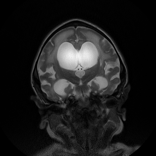 File:Cerebral manifestations of mucopolysaccharidosis type I (Radiopaedia 59171-66487 Coronal T2 11).jpg