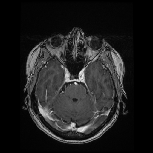 Cerebral metastases - melanoma (Radiopaedia 80972-94522 Axial T1 C+ 41).jpg