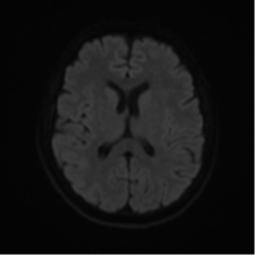 File:Cerebral metastases mimicking abscesses (Radiopaedia 45841-50131 Axial DWI 45).png