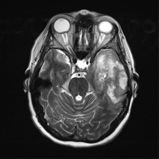 File:Cerebral metastasis mimicking glioblastoma (Radiopaedia 69155-78937 Axial T2 14).png