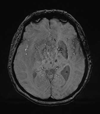 Cerebral metastasis to basal ganglia (Radiopaedia 81568-95413 Axial SWI 39).png