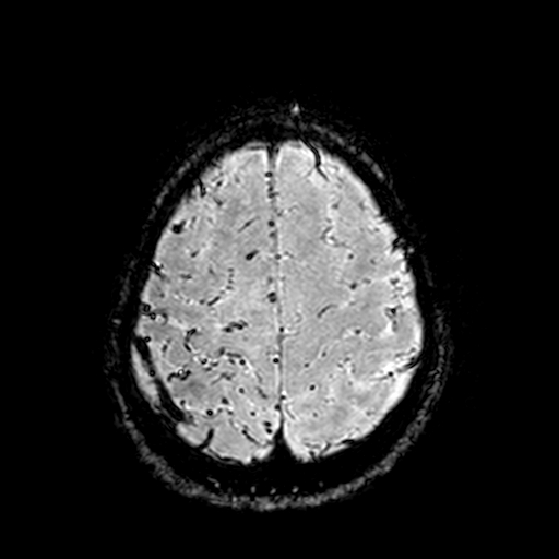 Cerebral parenchymal arteriovenous malformation (Radiopaedia 27280-27456 Axial SWI 104).jpg