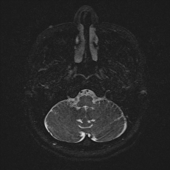 Cerebral ring enhancing lesions - cerebral metastases (Radiopaedia 44922-48817 F 7).jpg