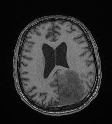 Cerebral toxoplasmosis (Radiopaedia 43956-47461 Axial T1 50).jpg