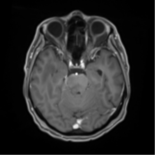 Cerebral toxoplasmosis (Radiopaedia 54575-60804 Axial T1 C+ 21).png