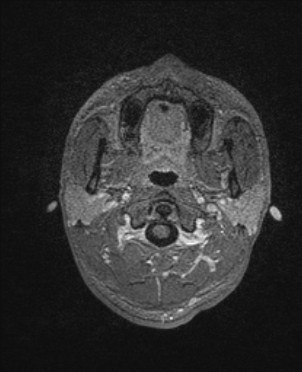 Cerebral toxoplasmosis (Radiopaedia 85779-101597 Axial T1 C+ 6).jpg