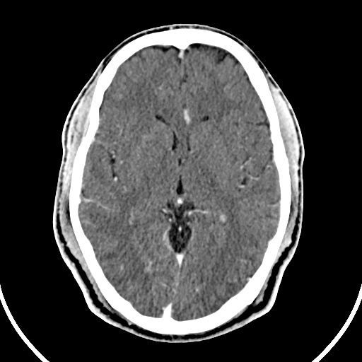 Cerebral venous angioma (Radiopaedia 69959-79977 B 43).jpg