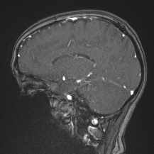 Cerebral venous infarction - hemorrhagic (Radiopaedia 81625-95505 Sagittal MRV 47).jpg
