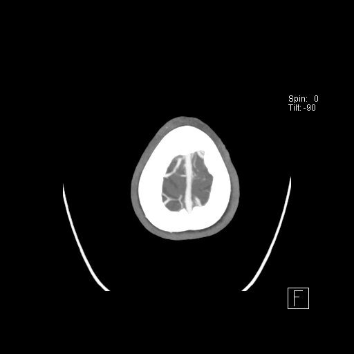 Cerebral venous infarction with hemorrhage (Radiopaedia 65343-74396 A 132).jpg