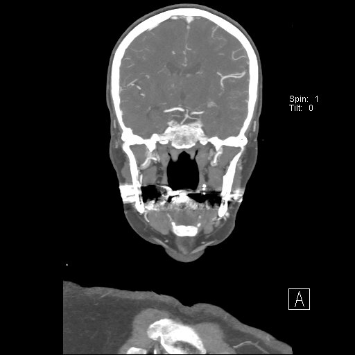 Cerebral venous infarction with hemorrhage (Radiopaedia 65343-74396 B 152).jpg
