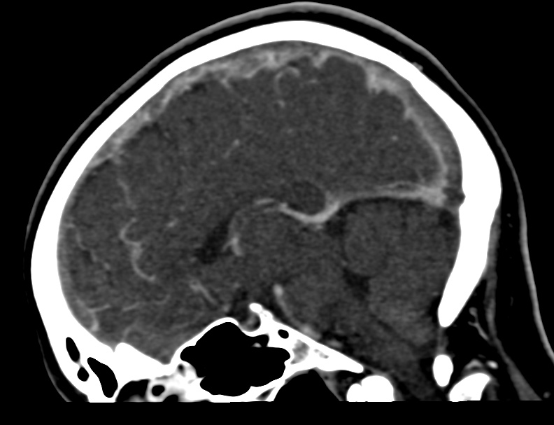 Cerebral venous sinus thrombosis (Radiopaedia 59224-66646 Sagittal C+ delayed 26).jpg