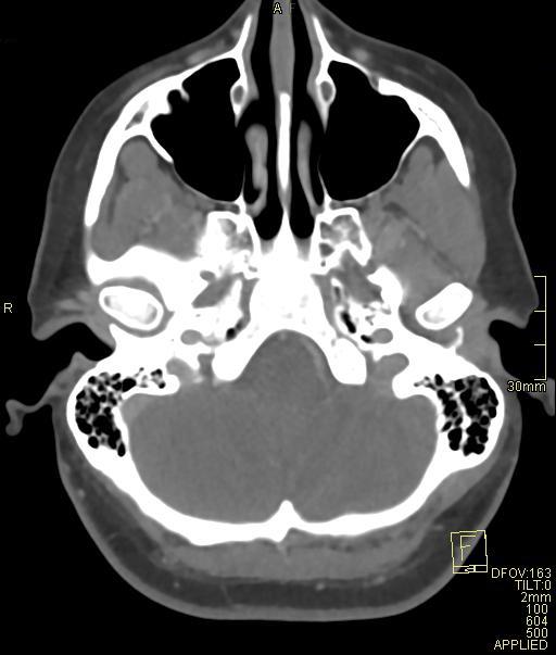 Cerebral venous sinus thrombosis (Radiopaedia 91329-108965 Axial venogram 17).jpg