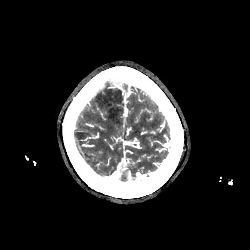 File:Cerebral venous throbmosis - hemorrhagic venous infarction (Radiopaedia 87318-103613 B 36).jpg