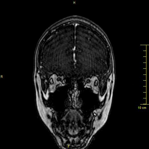 File:Cerebral venous thrombosis (Radiopaedia 23288-23351 MRV 12).JPG