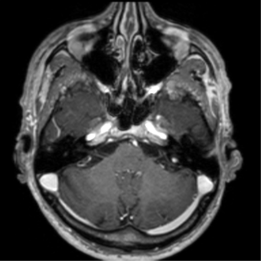 Cerebral venous thrombosis (Radiopaedia 38392-40469 Axial T1 C+ 21).png