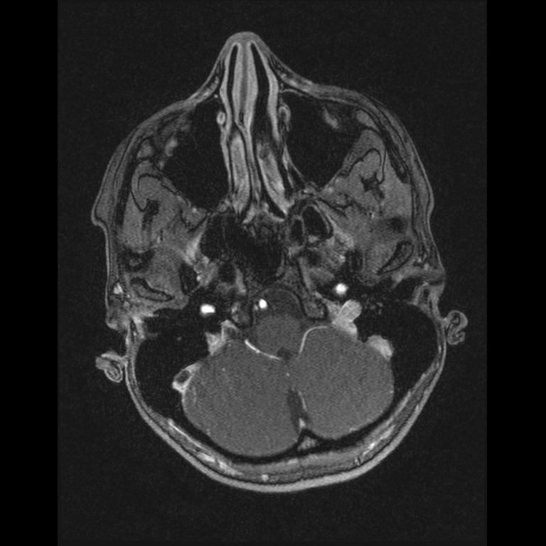 Cerebral venous thrombosis (Radiopaedia 45678-49854 Axial MRV 8).jpg