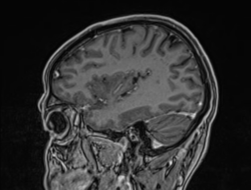 Cerebral venous thrombosis (Radiopaedia 71207-81504 Sagittal T1 C+ 48).jpg