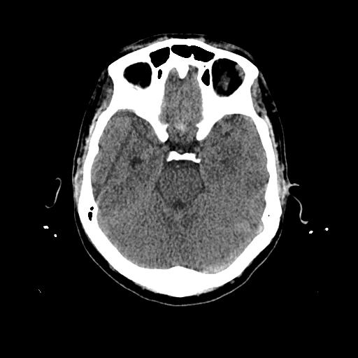 Cerebral venous thrombosis with venous hemorrhagic infarct (Radiopaedia 90354-107660 Axial non-contrast 18).jpg