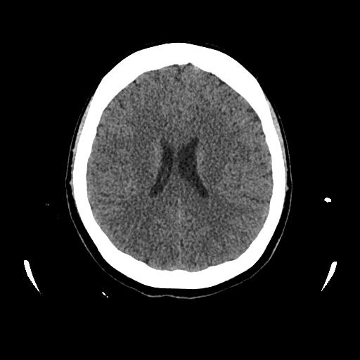 Cerebral venous thrombosis with venous hemorrhagic infarct (Radiopaedia 90354-107660 Axial non-contrast 32).jpg