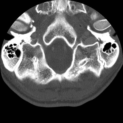 Cervical Pott disease (Radiopaedia 20374-20286 Axial bone window 7).jpg