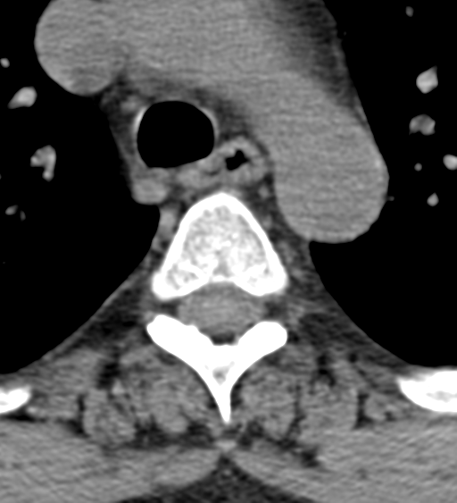 Cervical canal stenosis - OPLL and osteophytes (Radiopaedia 47329-51910 Axial non-contrast 78).png