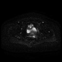 Cervical carcinoma (Radiopaedia 85405-101028 Axial DWI 27).jpg