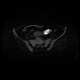 Cervical carcinoma (Radiopaedia 88010-104555 Axial DWI 39).jpg