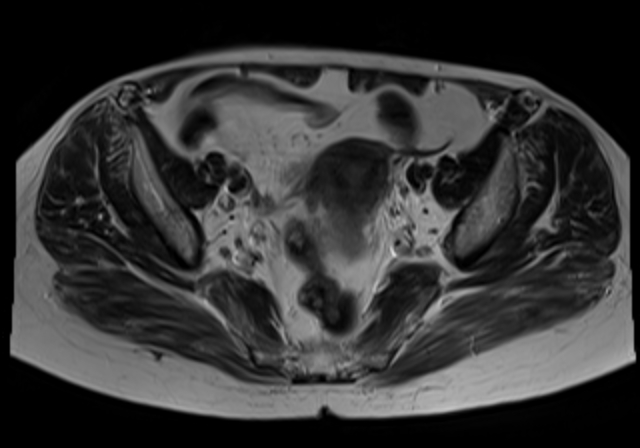 File:Cervical carcinoma (Radiopaedia 88312-104943 Sagittal T1 10).jpg