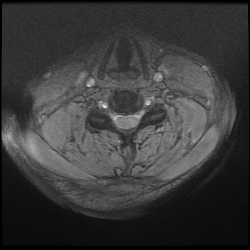 Cervical disc extrusion (Radiopaedia 59074-66364 F 29).jpg