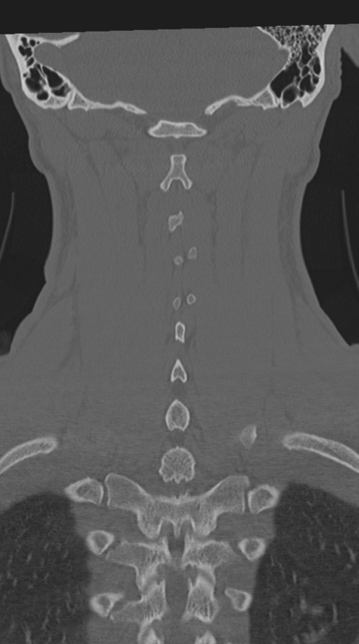 Cervical intercalary bone (Radiopaedia 35211-36748 Coronal bone window 58).png