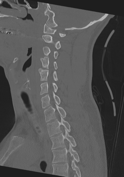 Cervical intercalary bone (Radiopaedia 35211-36748 Sagittal bone window 33).png