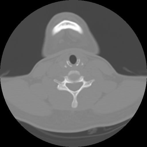 Cervical rib (Radiopaedia 71110-81363 Axial non-contrast 38).jpg