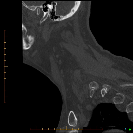 Cervical spine fracture - ankylosing spondylitis (Radiopaedia 76835-88706 Sagittal bone window 18).jpg
