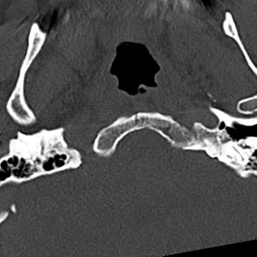Cervical spine fracture - chalk stick (Radiopaedia 39116-41323 Axial bone window 1).png