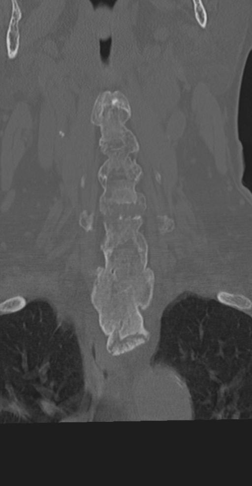 Cervical spine fracture in the setting of ankylosis (Radiopaedia 37038-38715 Coronal bone window 22).png